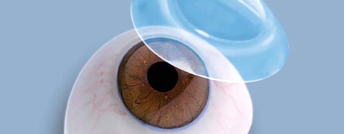 Уорп Иф ван дер: «Руководство по подбору склеральных линз» (рос. мовою)