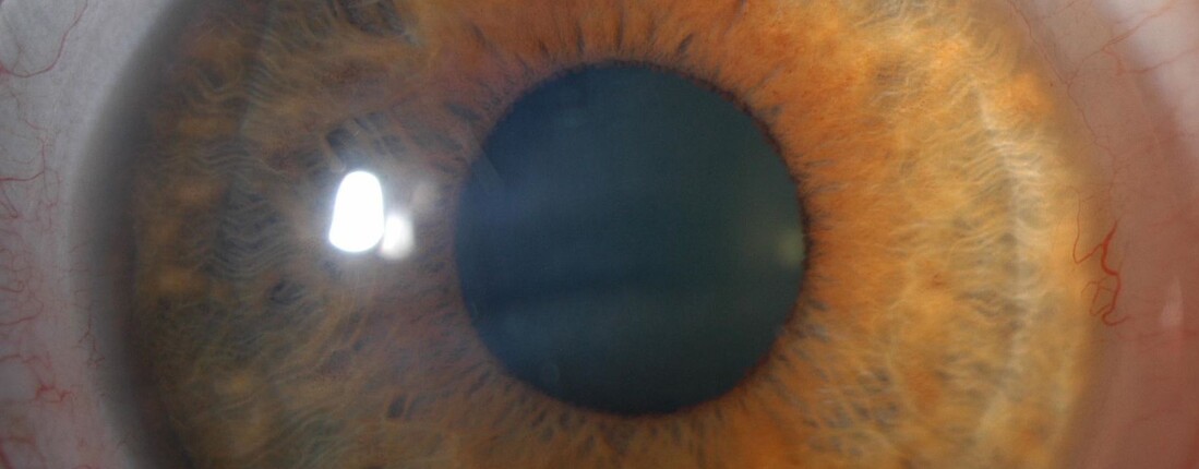 Melissa Barnett, Daddi Fadel: «Клінічний посібник для успішного підбирання склеральних лінз» (рос. мовою)