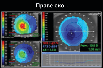 Рисунок 2. Порівняння стану рогівки правого ока без (вгорі зліва) та з (внизу зліва) лінзами Soft K II