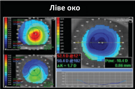 Рисунок 3. Порівняння&nbsp;стану&nbsp;рогівки&nbsp;лівого&nbsp;ока&nbsp;без&nbsp;(вгорі&nbsp;зліва) та&nbsp;з&nbsp;(внизу&nbsp;зліва) лінзами&nbsp;Soft K II